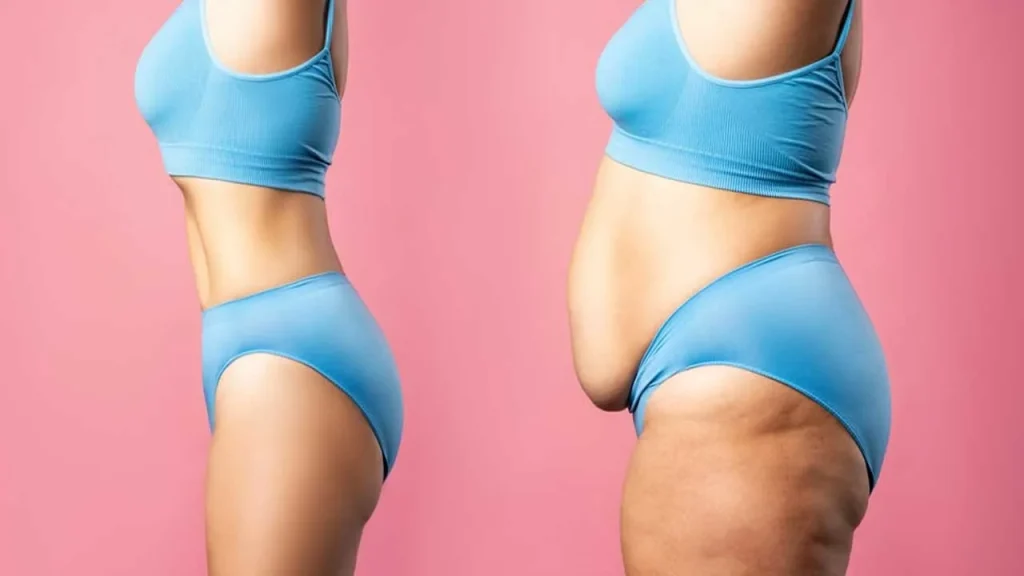 shrink skin after weight loss